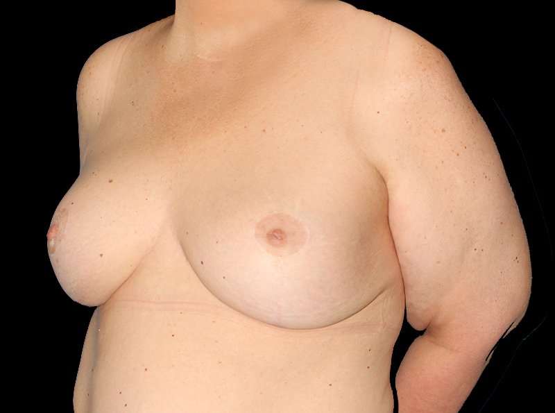 Revision Breast Surgery Before & After Patient #1195
