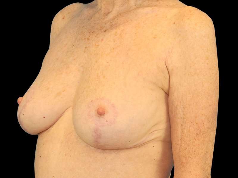Breast Reduction Before & After Patient #1239