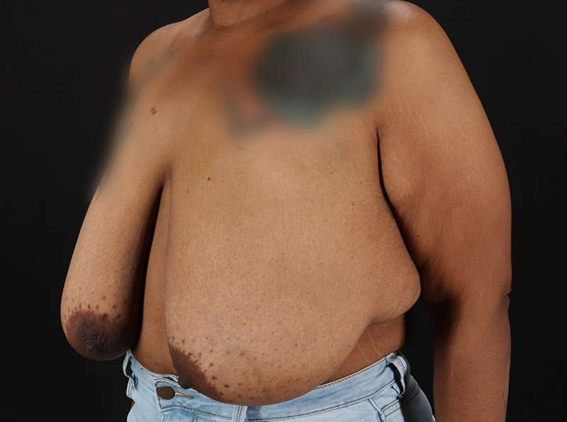 Breast Reduction Before & After Patient #1272