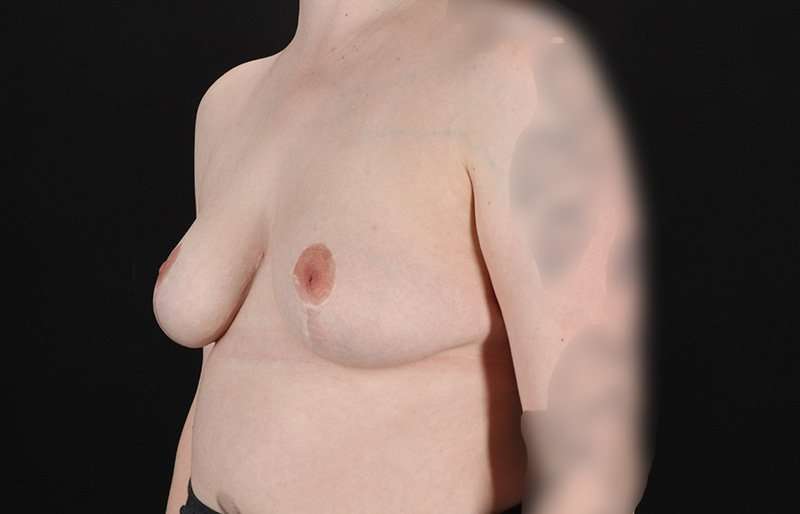 Breast Reduction Before & After Patient #1305