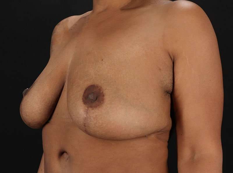 Breast Reduction Before & After Patient #1387