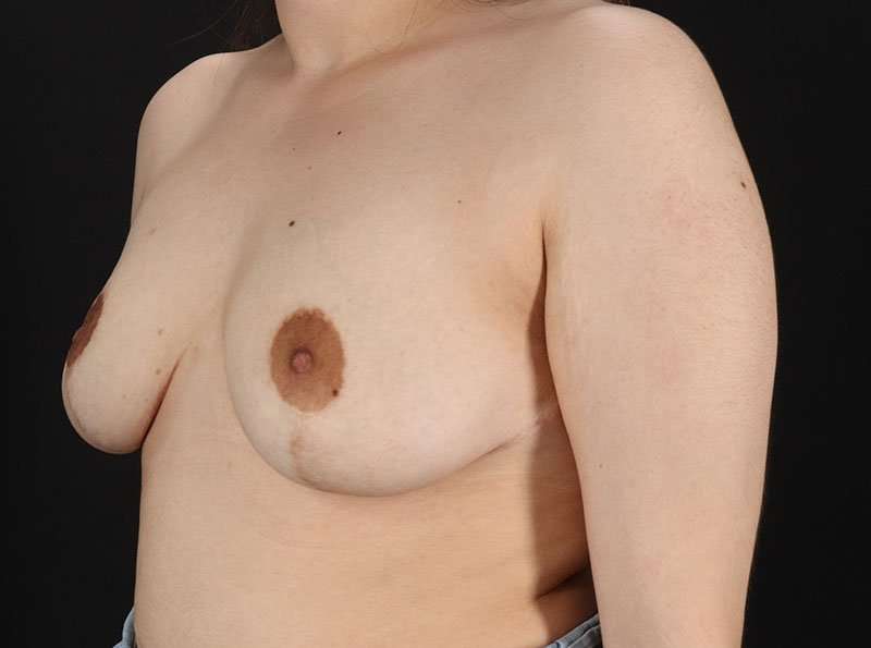Breast Reduction Before & After Patient #1398