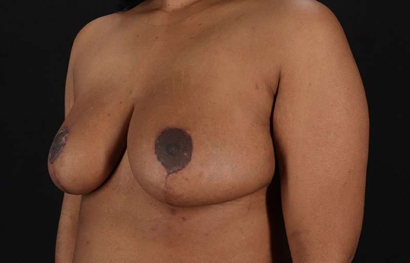 Breast Reduction Before & After Patient #1431