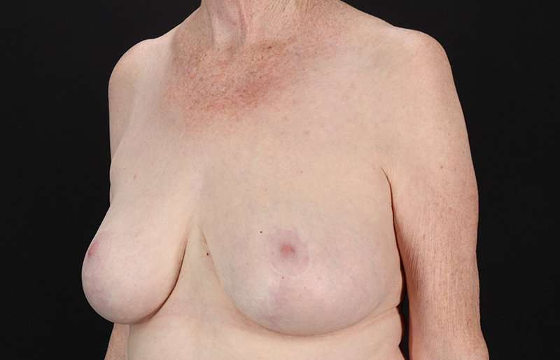 Breast Reduction Before & After Patient #1442