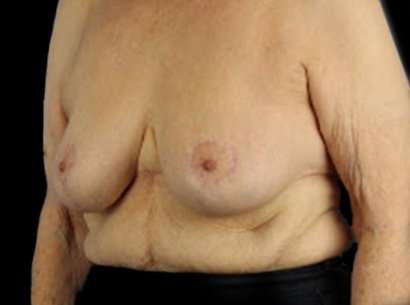 Breast Reduction Before & After Patient #1464