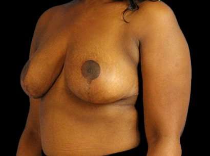 Breast Reduction Before & After Patient #1475