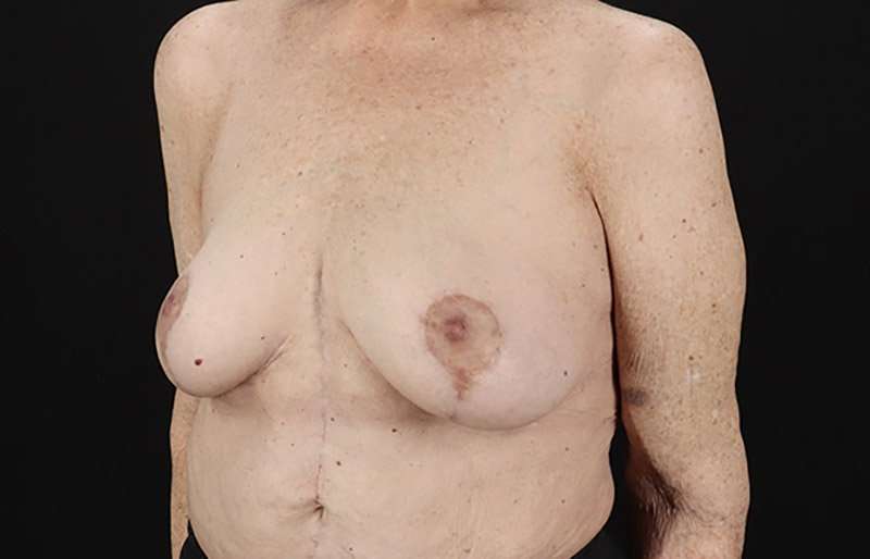 Augmentation/Lift Before & After Patient #1544