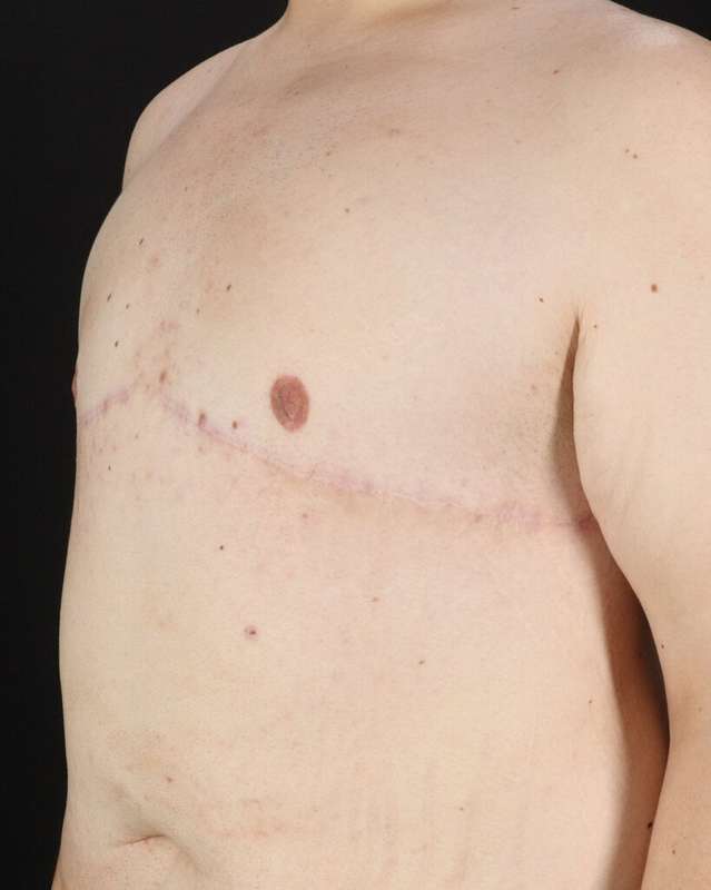 Gynecomastia Before & After Patient #1603