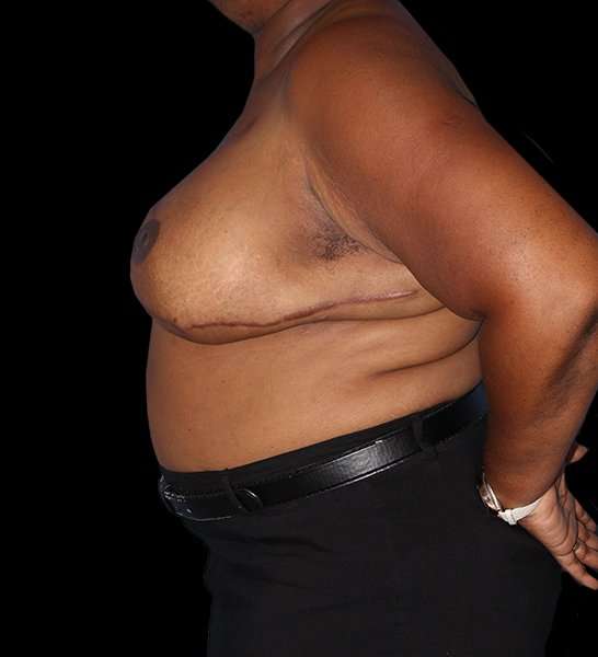 DIEP Flap Reconstruction Before & After Patient #1623