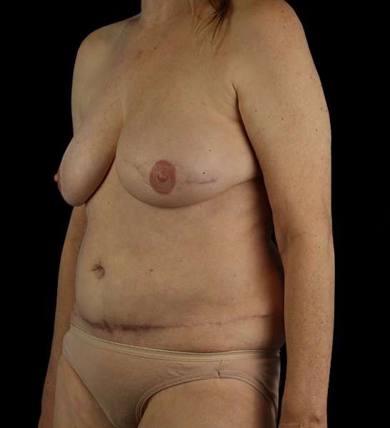 DIEP Flap Reconstruction Before & After Patient #1634
