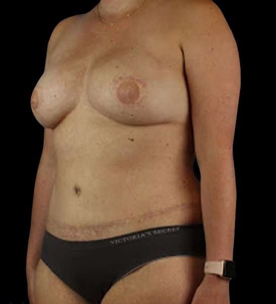 DIEP Flap Reconstruction Before & After Patient #1645