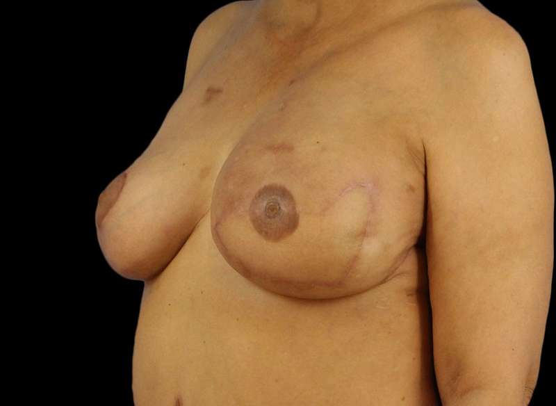 DIEP Flap Reconstruction Before & After Patient #1707