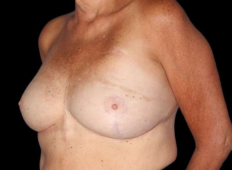 Oncoplastic Reconstruction Before & After Patient #1762