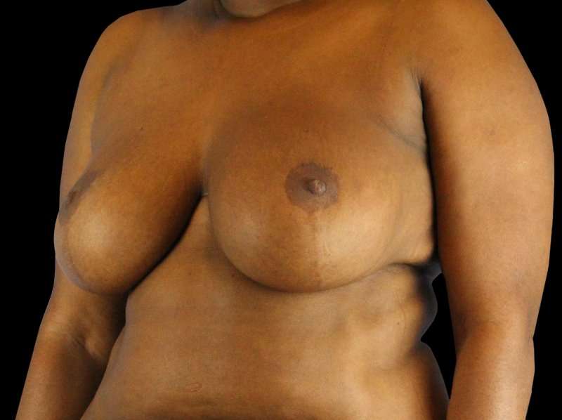 Oncoplastic Reconstruction Before & After Patient #1784