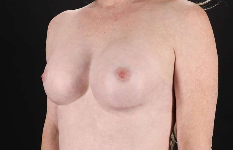 MTF Breast Augmentation Before & After Patient #1820