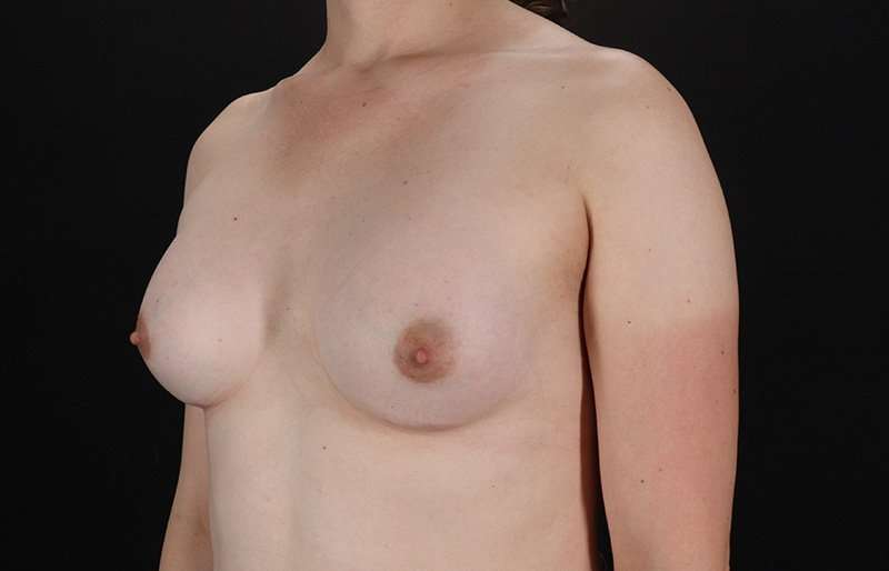 MTF Breast Augmentation Before & After Patient #1842