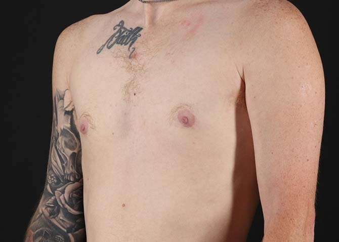 FTM Chest Contouring Before & After Patient #1864