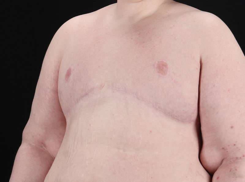 FTM Chest Contouring Before & After Patient #1875