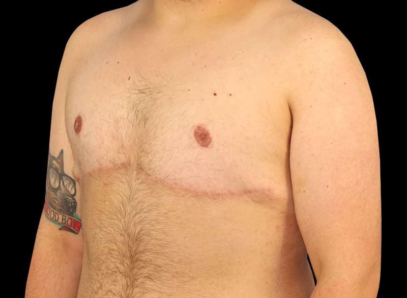FTM Chest Contouring Before & After Patient #1886