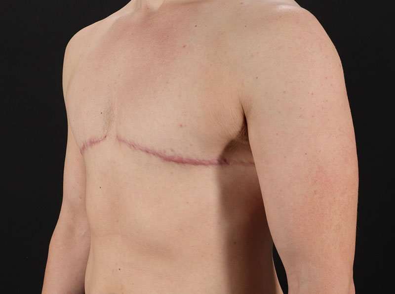 FTM Chest Contouring Before & After Patient #1918