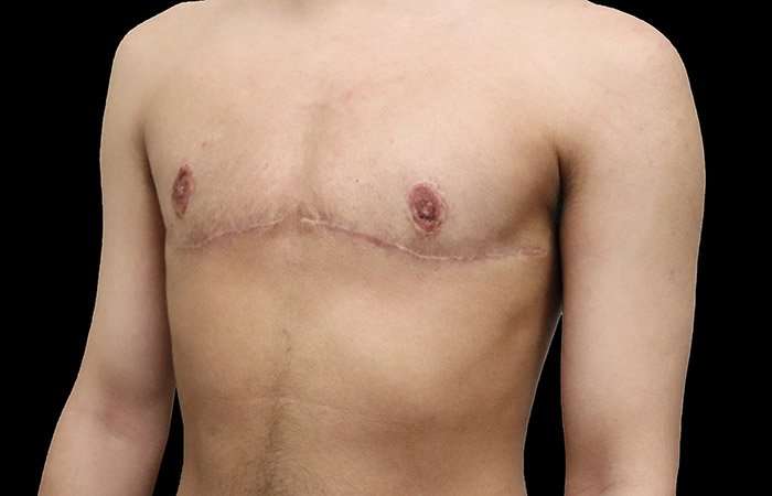 FTM Chest Contouring Before & After Patient #1929