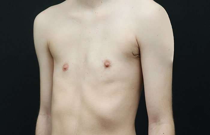 FTM Chest Contouring Before & After Patient #1940