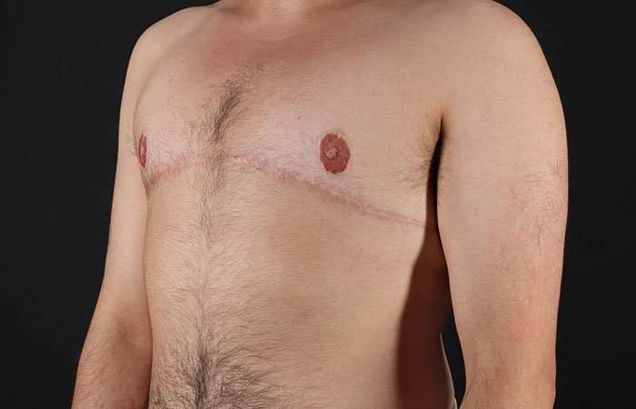 FTM Chest Contouring Before & After Patient #1951