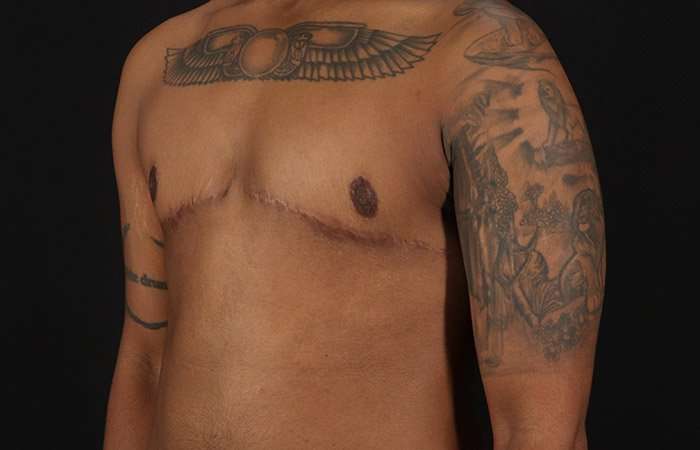 FTM Chest Contouring Before & After Patient #1962