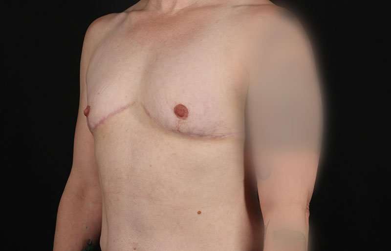 FTM Chest Contouring Before & After Patient #1973