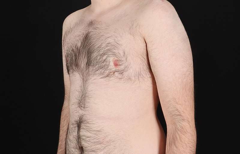 FTM Chest Contouring Before & After Patient #1984