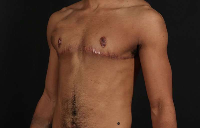FTM Chest Contouring Before & After Patient #1995