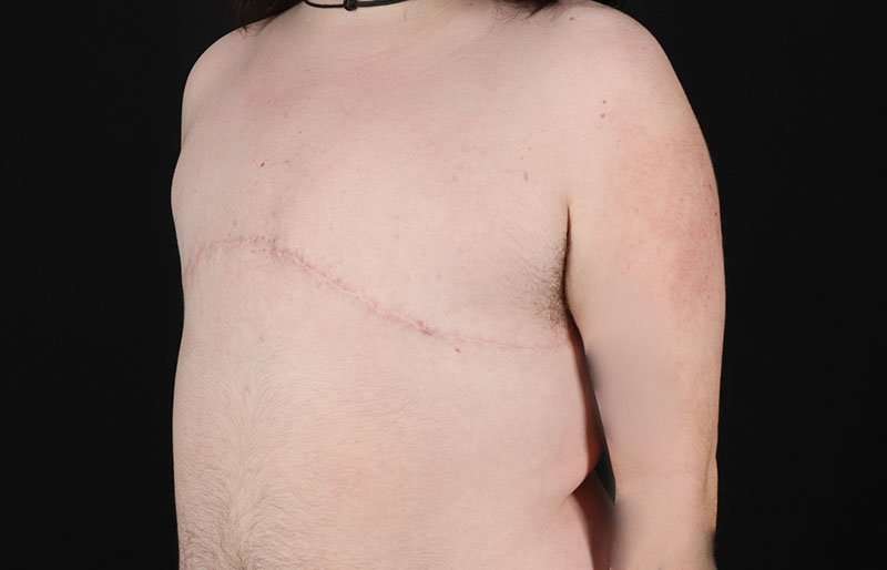 FTM Chest Contouring Before & After Patient #2006