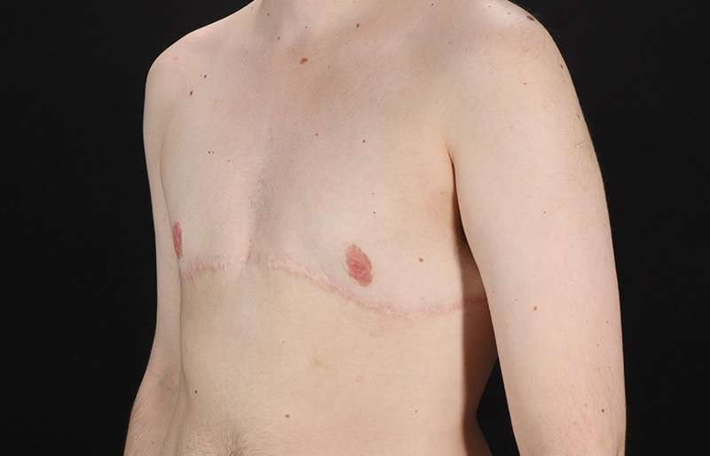 FTM Chest Contouring Before & After Patient #2017