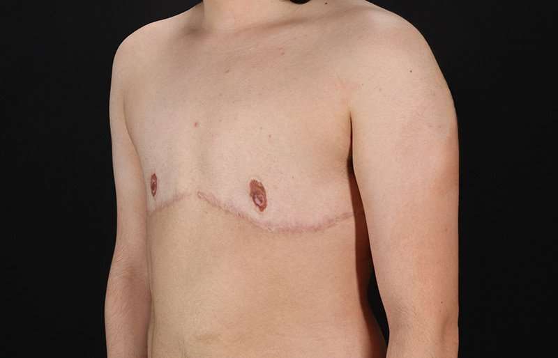 FTM Chest Contouring Before & After Patient #2028