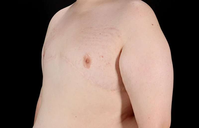 FTM Chest Contouring Before & After Patient #2039