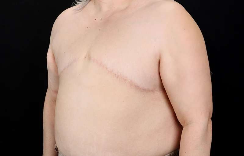 FTM Chest Contouring Before & After Patient #2050