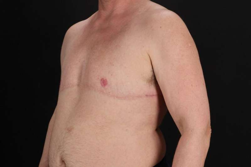 FTM Chest Contouring Before & After Patient #2061