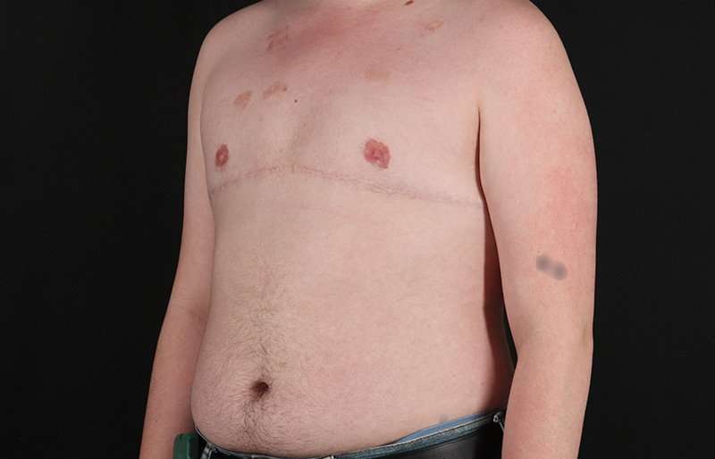 FTM Chest Contouring Before & After Patient #2072