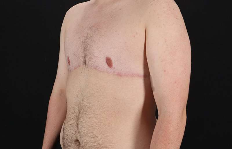 FTM Chest Contouring Before & After Patient #2083
