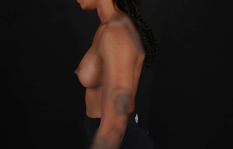 Breast Augmentation - Implant Before & After Patient #1023