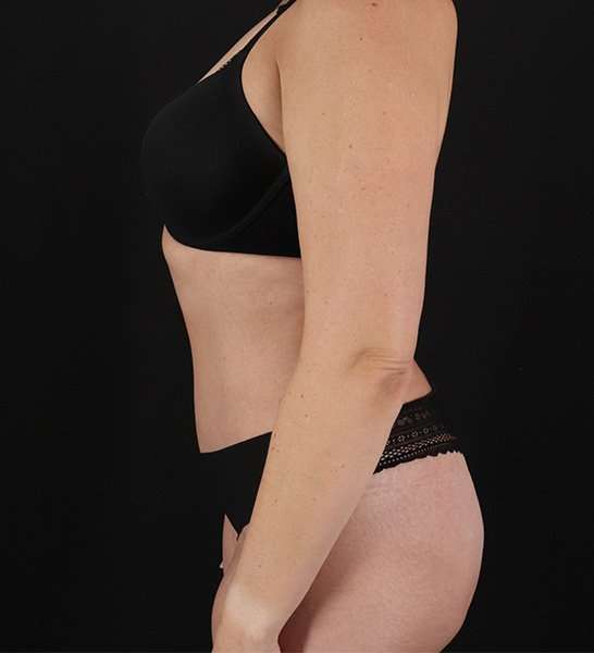 Tummy Tuck Before & After Patient #2128