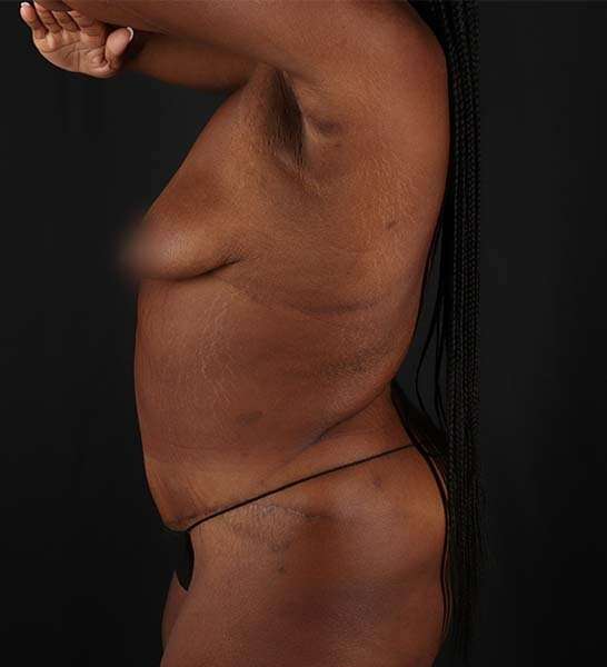 Tummy Tuck Before & After Patient #2139
