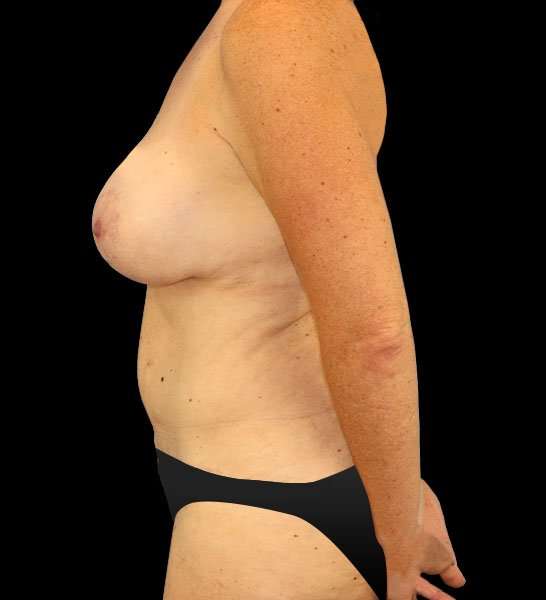 Tummy Tuck Before & After Patient #2157