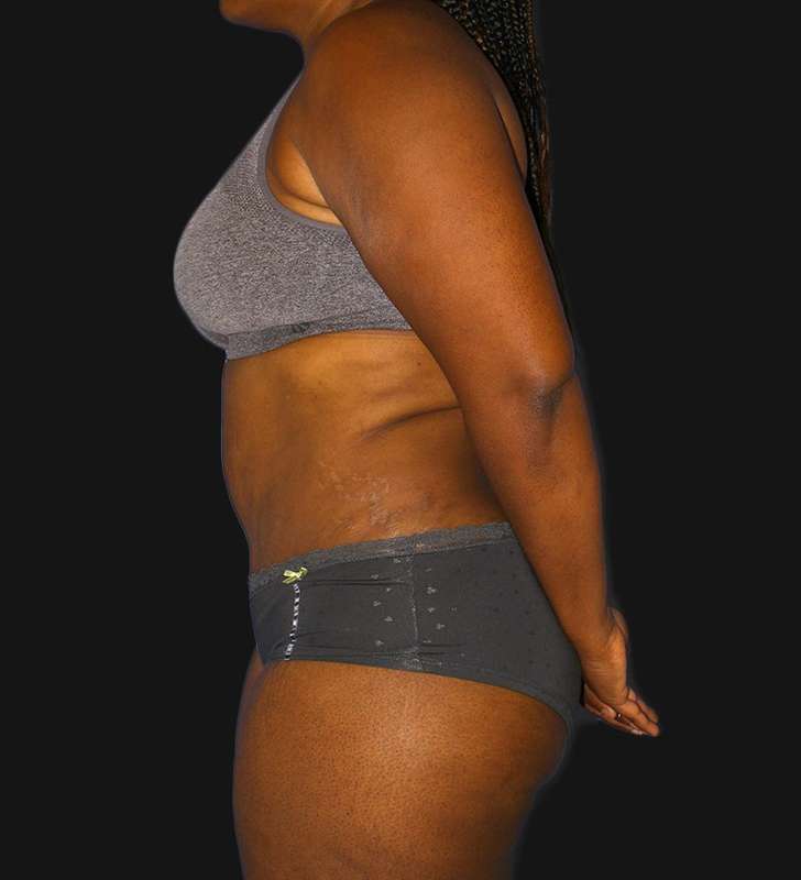 Tummy Tuck Before & After Patient #2179