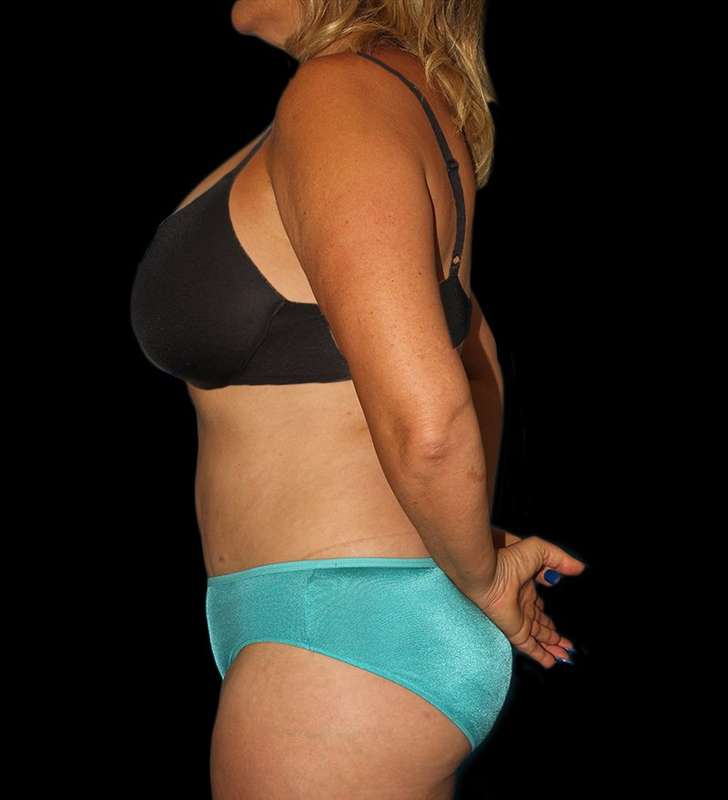 Tummy Tuck Before & After Patient #2190