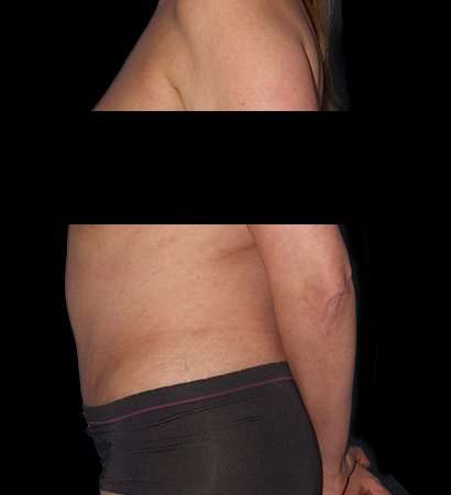 Tummy Tuck Before & After Patient #2201