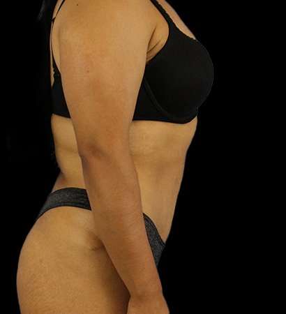 Tummy Tuck Before & After Patient #2212