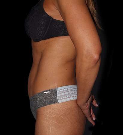 Tummy Tuck Before & After Patient #2269