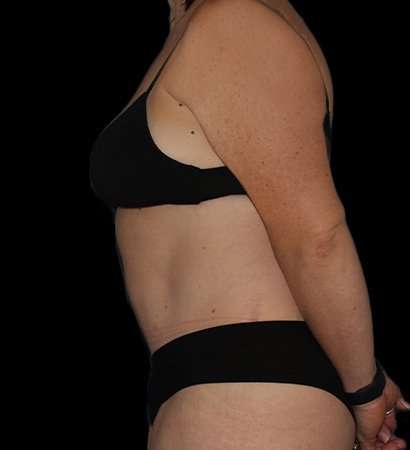 Tummy Tuck Before & After Patient #2280