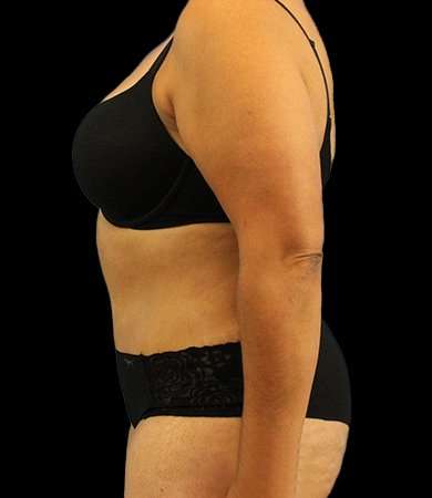 Tummy Tuck Before & After Patient #2291